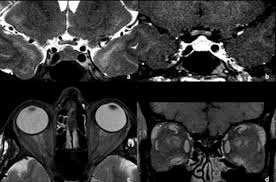 {ad_unit_id:app_resource_leaderboard,width:728,height:90,rtype:mindmap 1.1.1.1.1.1.2 vantagens da ressonância magnética. Papel Da Imagem Por Ressonancia Magnetica No Diagnostico Diferencial Das Doencas Desmielinizantes Artigos Fleury Medicina E Saude