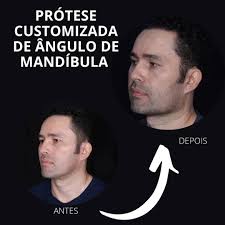 Harmonização Facial Definitiva com o uso de Próteses Faciais