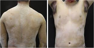 Image result for Anhidrosis