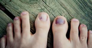 Tirnak Morarmasina Ne Iyi Gelir Morarma Com