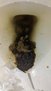 Image result for dark black stool human poop