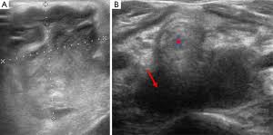 The earlier the better, so if you have persistent symptoms, microscopic blood in your urine, a urologist is a good next step. Diagnostic Imaging Of Benign And Malignant Neck Masses In Children A Pictorial Review Brown Quantitative Imaging In Medicine And Surgery