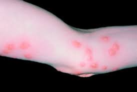 how to get rid of bed bugs the signs that say you have them and how to prevent them mirror online