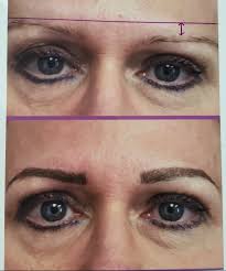 Correction with Permanent Micro-Bladed Brow Procedure