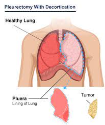 We did not find results for: Mesothelioma Life Expectancy Know What Factors Affect Lifespan