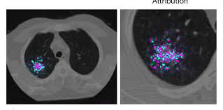 Ct scans can detect bone and joint problems, like complex bone fractures and tumors. Google Shows How Ai Might Detect Lung Cancer Faster And More Reliably Mit Technology Review