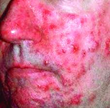 Image result for demodex rosacea