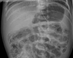 Image result for Necrotizing Enterocolitis