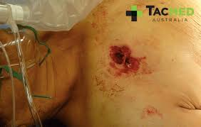 It may not need a single suture or it may need stitches to close it up. Warning Graphic Images Through And Through Gunshot Wound To The Chest Sofrep