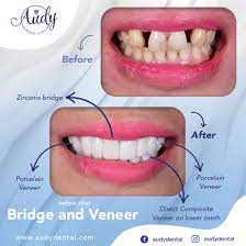 Crown dan bridges tidak dapat dilepas pasang. Gigi Tiruan Jembatan Bridge Audy Dental