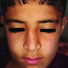 Pityriasis alba pityriasis lichenoides pityriasis rosea pityriasis rubra pilaris pityrosporum folliculitis Pdf Psoriasis Pityriasis Alba And Vitiligo Ppv Are A Triad Of One Disease New Observation