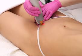 The very idea of getting my bikini. Bikini Line Laser Hair Removal In Vancouver Yaletown Limelight Wellness Centre