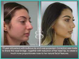 If the traditional job hunt isn't working, then consider these websites that offer odd jobs that make good money. Rhinoplasty Nose Job In London Uk Photos Cost Faqs