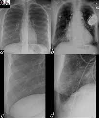 Image result for CHF Observation Unit