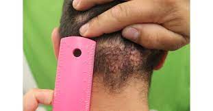 If you shave too close to the skin surface, chances are that the cut there are a variety of causal factors responsible for ingrown hairs on the butt and even leading to low back pain which might further point out to pilonidal cyst if the ingrown hair cyst was not taken. Groundbreaking Discoveries For Treatment Of Back Of Head Razor Bumps