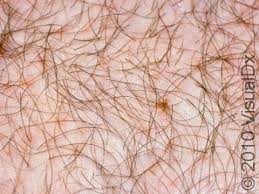 Image result for pubic lice symptoms