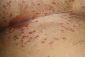 Image result for Candidiasis under breasts