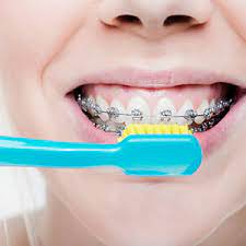 Rinse your toothbrush and apply tooth paste. How To Brush Your Teeth With Braces Orthodontics Warwick Ri