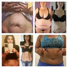 The 12 Most Incredible Sagging Skin Transformations That Changed Skin Care Saggy Skin Sagging Skin Excess Skin Skin Removal Surgery