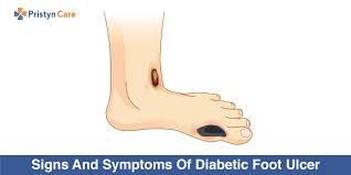 Diabetic ulcers are usually formed due to the following causes. Signs And Symptoms Of Diabetic Foot Ulcer Pristyn Care