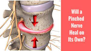 Will A Pinched Nerve Heal On Its Own? Spinecare - St. Joseph, Mi  Chiropractor