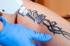 Laser and ipl tattoo removal is safe for application to the pubic regions including the reproductive organs of both sexes. Location Matters For Tattoo Removal National Laser Institute