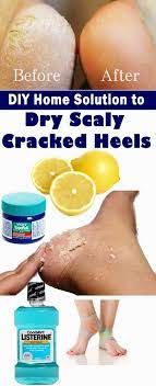 Diy Home Solution To Dry Scaly Cracked Heels Style Vast