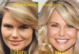 It's more than just breast augmentation and rhinoplasty. Christie Brinkley Plastic Surgery Plastic Surgery Feed