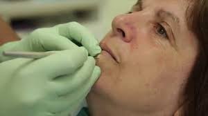 Mole Lower Lip Excision Youtube mole lower lip excision