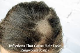 Some fish contain high levels of mercury, and high levels of mercury can lead to hair loss, she says. Infections That Cause Hair Loss Ringworm Scalp And More Expert Bulletin