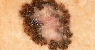 Basal cell carcinoma is more common in patients with fair skin, especially after prolonged sun exposure, frequent tanning, and other risk factors. Skin Cancer Could Be Hiding Where You D Never Expect The Sole Of Your Foot Cbs News