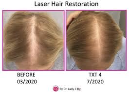 Plus, it also has the power to alter the growth cycle of your hair to your advantage. The New Wave Of Hair Restoration Lasers Dy Dermatology Center