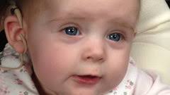 Evie: The Youngest Cochlear Implant Recipient