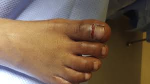 Fractured broken big toe pictures. Physical Examination Identifies Seymour Fractures Of The Great Toe The Journal Of Pediatrics