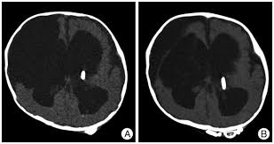 A Postoperative Computed Tomography Ct Scan Of The Initial Download Scientific Diagram