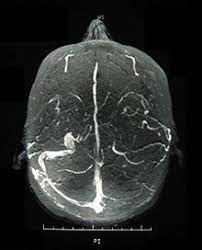 Behcet S Disease Wikipedia