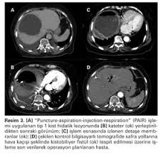 We did not find results for: Evaluation Of Cyst Hydatid Cases One Center S Experience Over A Two Year Period Kist Hidatik Olgularinin Degerlendirilmesi Tek Merkezden Iki Yillik Deneyim Document Gale Academic Onefile