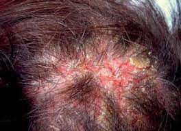 The Value Of Trichoscopy In The Differential Diagnosis Of Scalp Lesions In Pemphigus Vulgaris And Pemphigus Foliaceus