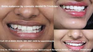 Smile Makeover By Cosmetic Dentist Dr Trivikram In Bangalore Minimal Preparation Porcelain Ceramic Veneers Are Cosmetic Dentist Dental Veneers Veneers Teeth