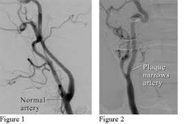 It supplies structures present in the cranial cavity and orbit. Angiogram Of The Carotid Artery Burlington Ear Nose Throat Clinic