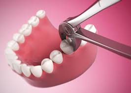 Family dentist pakuranga provides tooth extraction in the east auckland area covering howick, botany downs, highland park, panmure, tamaki, half moon bay & somerville. Tooth Extraction Auckland Greenlane Dental Services