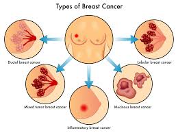 Back in the days when no one had heard of inflammatory breast cancer (ibc), a red spot on the breast that looked like a bug bite didn't worry anyone. What Is Inflammatory Breast Cancer Breast Cancer Conqueror