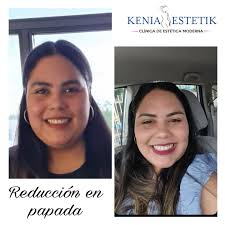 Felicidades a nuestra hermosa clienta por su compromiso y disciplina!! Ella  se encuentra realizando su tratamiento de reducción de papada y aquí en su  segunda sección espectacular su cambio. Si deseas mejorar