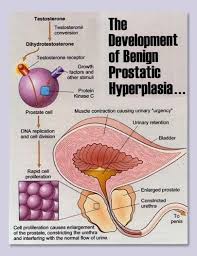 The Development Of Benign Prostatic Hyperplasia Benign Prostatic Hyperplasia Enlarged Prostate Prostate