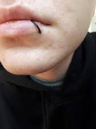 Ist Mein Labret Piercing Entzundet Gesundheit Und Medizin Lippenpiercing