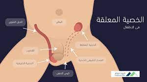 الخصية المعلقة عند الاطفال ما اسبابها وما هى طرق تشخيصها وعلاجها