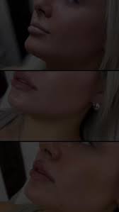 My beautiful client wanted to keep her lips looking natural yet more  defined., By softly enhancing the borders with just a minimal amount of  filler, we created natural symmetry while preserving her ...