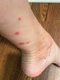 Ant bites are not the most dangerous bites a person can be subjected to but they do have their negative effects and risks. Home Remedies For Fire Ant Bites That Really Work Convos With Karen
