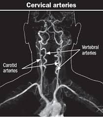 There are two large arteries in the neck, one on each side. When A Pain In The Neck Is Serious Harvard Health