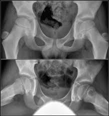 Perthes disease is a childhood hip disorder caused by a disruption of blood flow to the ball of the hip joint, or femoral head. The Radiology Assistant Hip Pathology In Children